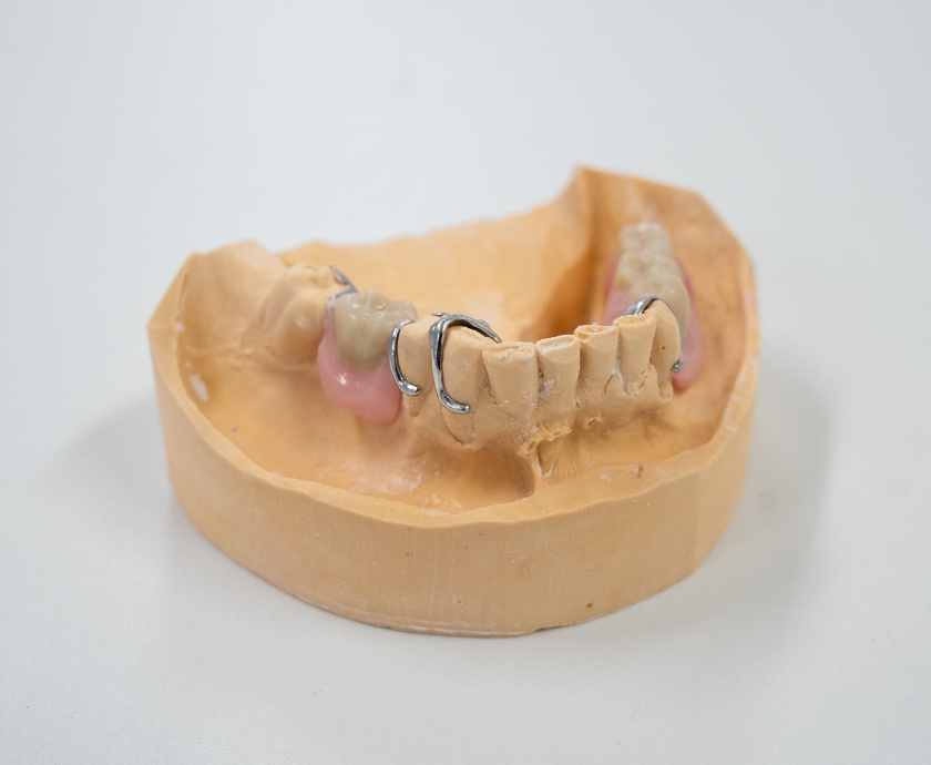 Gedeeltelijk Kunstgebit